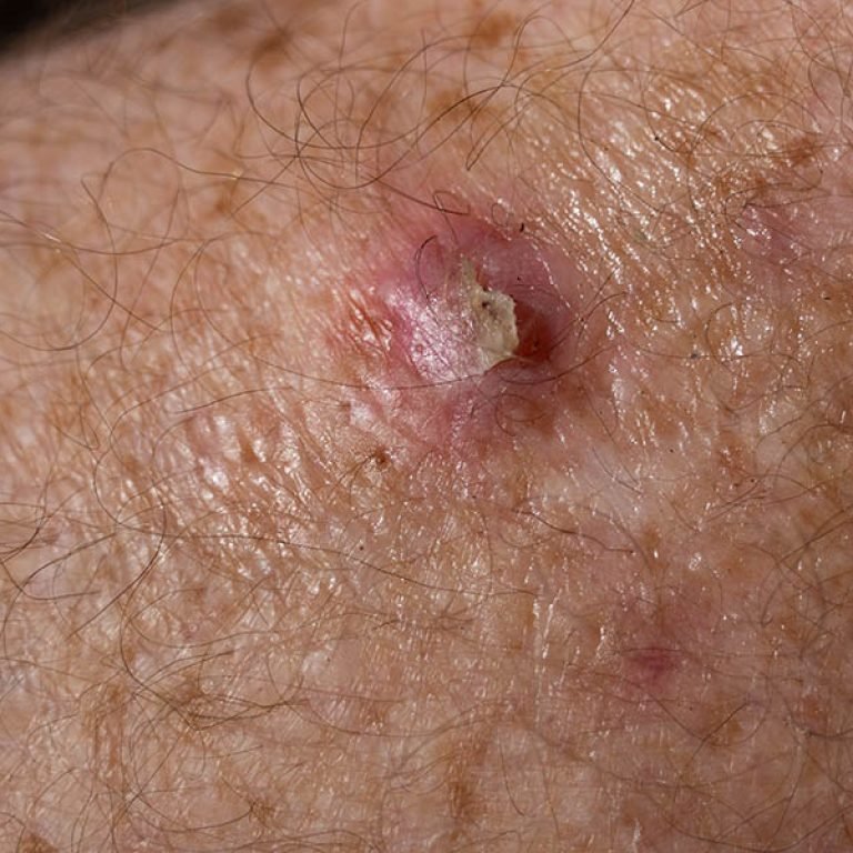 SCC or BCC skin cancer on senior males' leg waiting for surgery.
